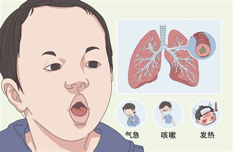 小孩子咳嗽|孩子咳嗽总不好？医生：三种咳嗽并不同，分清楚再吃药！